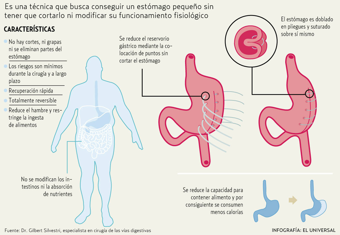 Indice De Mortalidad Es Infimo Tras Cirugia De Plicatura Gastrica